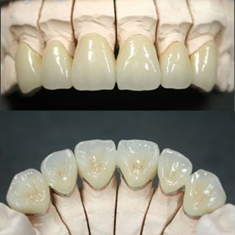 钴铬合金烤瓷冠、桥